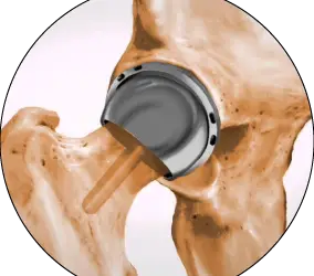 Lawsuits filed against defective Stryker Accolade hip replacement devices